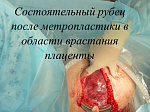 14 февраля 2023 года врачами родильного отделения Клиники БГМУ была родоразрешена первая пациентка в республике Башкортостан, которая забеременела и родила доношенного малыша, после органосохраняющей операции при врастании плаценты